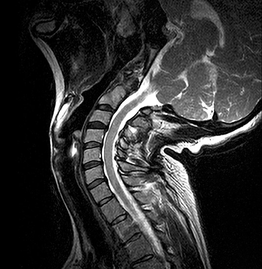 MRI Cervical Spine VariPOSE Scan (AI Enhanced)